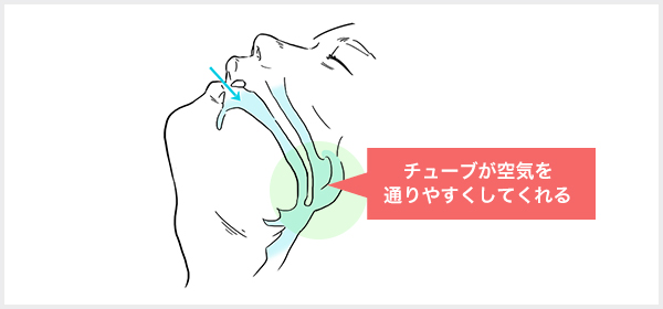 ナステントとは鼻からシリコン製のやわらかいチューブを入れる