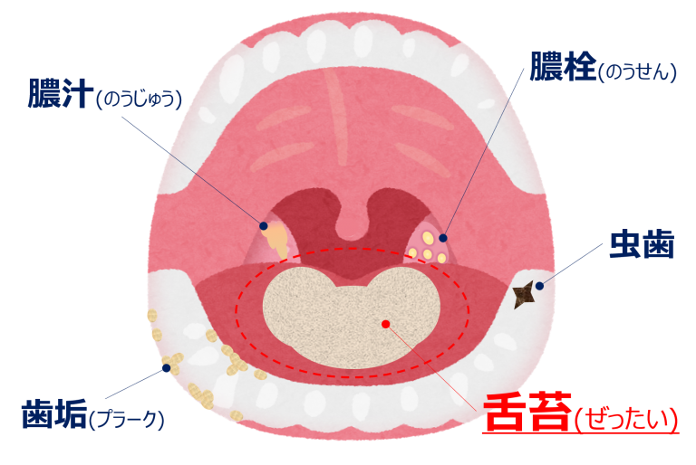 口臭を治すなら舌苔ぜったい対策を
