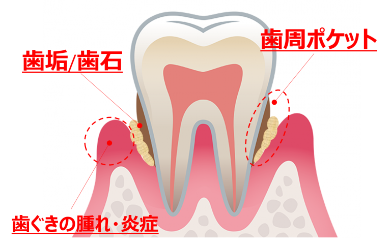歯みがきで歯周病を防ごう
