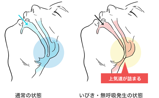 空気の通り道がふさがってしまう