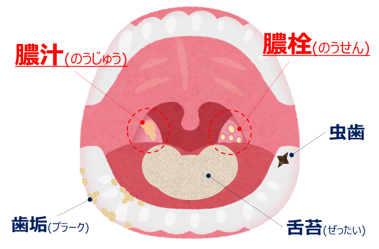 膿栓や膿汁も口臭の原因