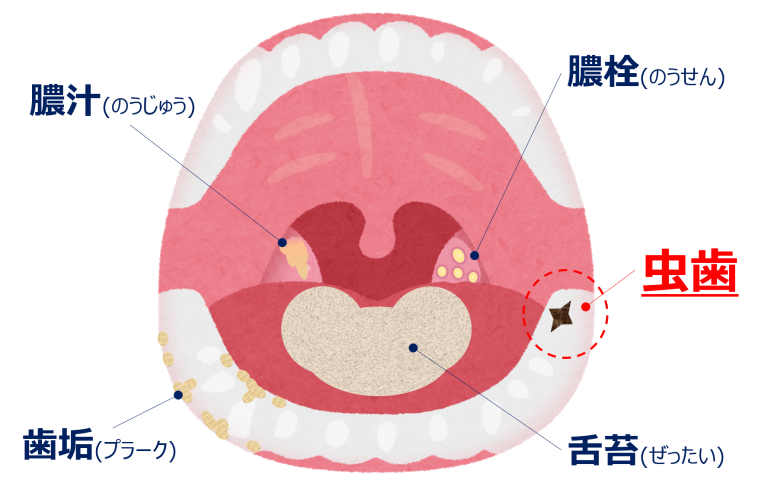 虫歯も口臭の原因に